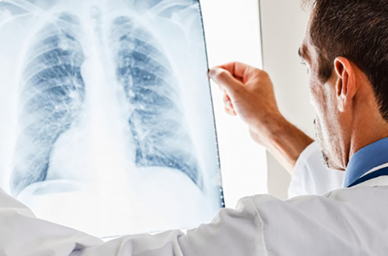 ԱՀԿ. 2016-ին ավելի քան 10 միլիոն մարդ հիվանդացել է տուբերկուլոզով