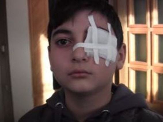 Աշակերտի աչքը վնասած ուսուցչի գործը վերաքննիչ դատարանում է. ՀՔԱՎ