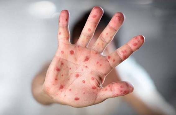 Հայաստանում արձանագրվել է կարմրուկի երկրորդ բերովի դեպքը