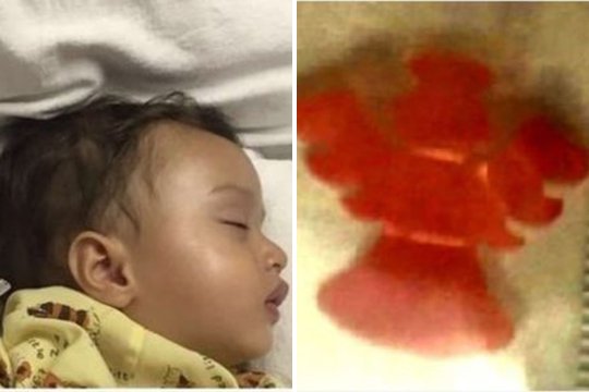 Երկու շաբաթ չեն կարողացել հայտնաբերել փոքրիկի կոկորդում մնացած խաղալիքը